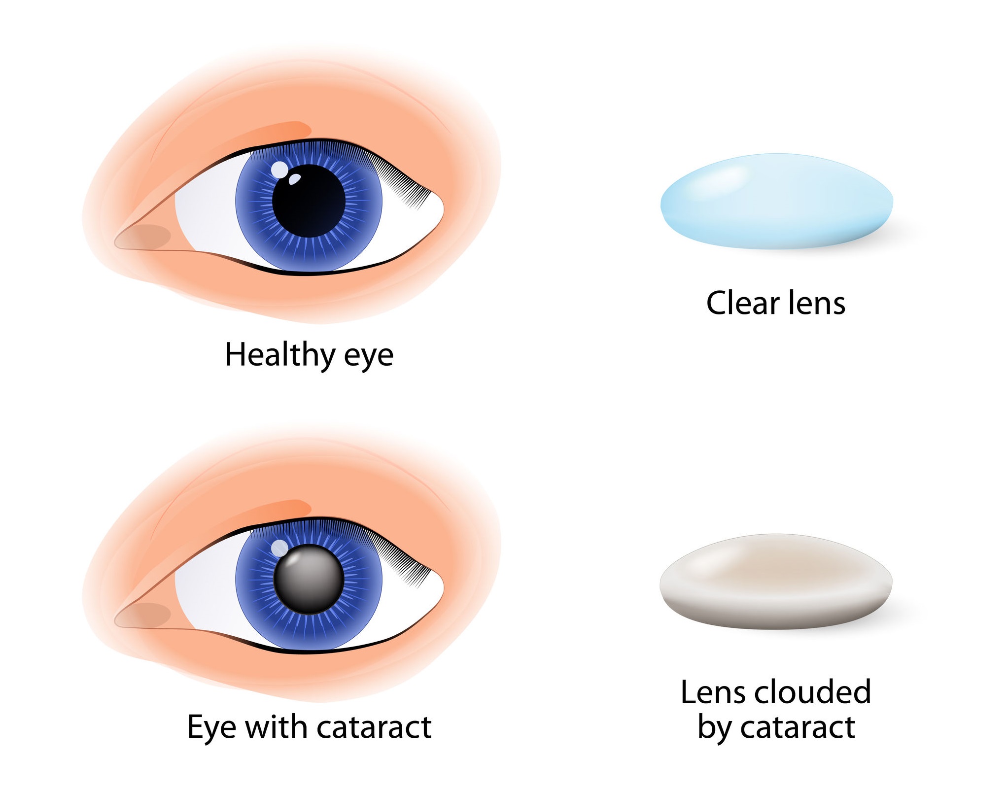 cause of cataract