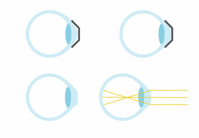 Overnight Corneal Reshaping